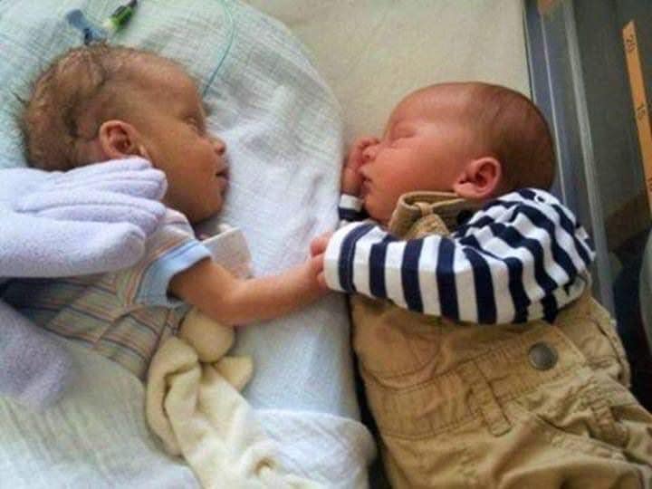 Nurse Puts Dying Baby Next To Her Twin. She Gives Her A ‘Hug’ That Leads To A Miracle